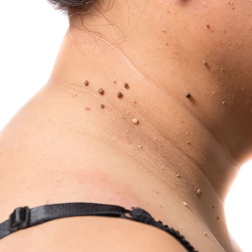 Skin lesion removal